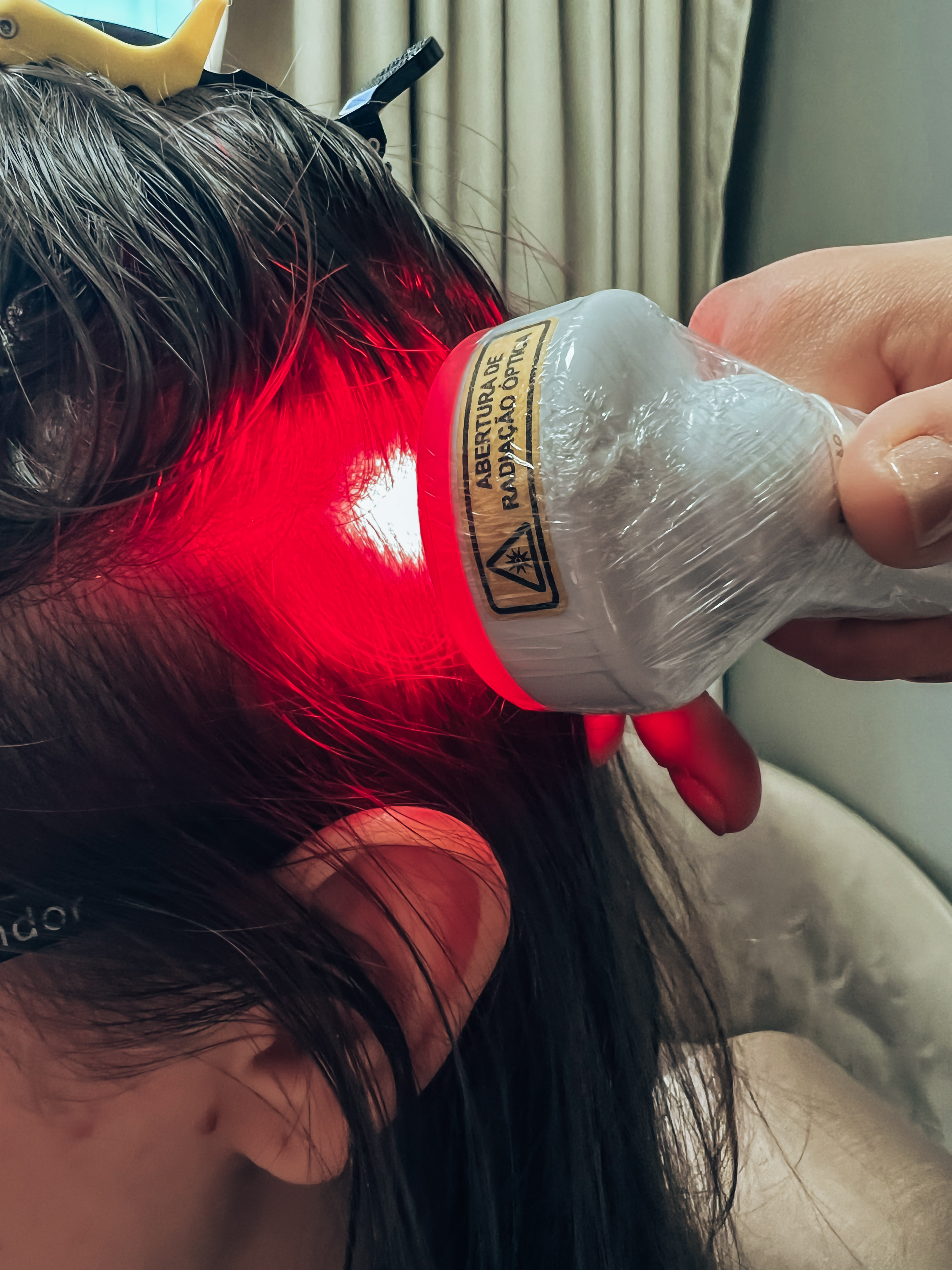 Resultado antes e depois - Laser capilar